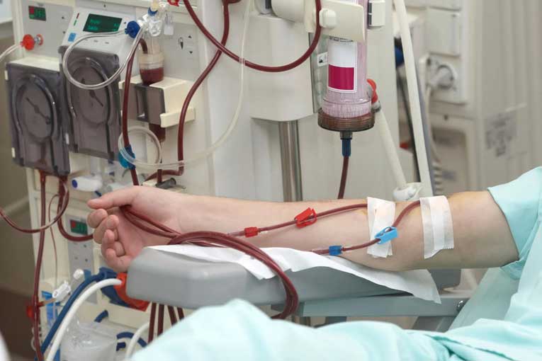 hemodialysis